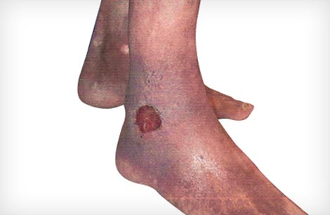 Venos Leg Ulcer Treatment in DDK Hospital Nagercoil