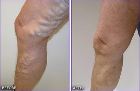 Varicose_Veins