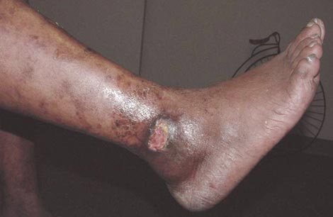 Venos Leg Ulcer Treatment in DDK Hospital Nagercoil